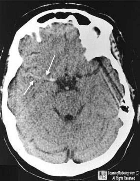 Hyperdense Middle Cerebral Artery Sign (Dense MCA Sign)
